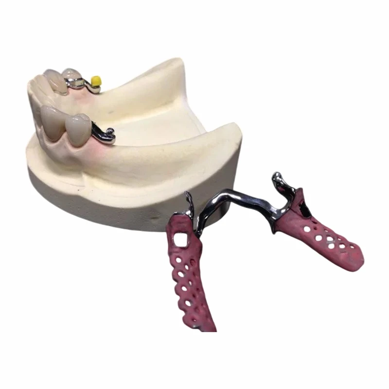 Prothèse partielle à armature métallique avec fixation de précision Keyway